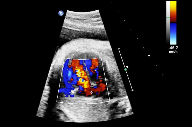 Sri veda diagnostics Foetal echo
